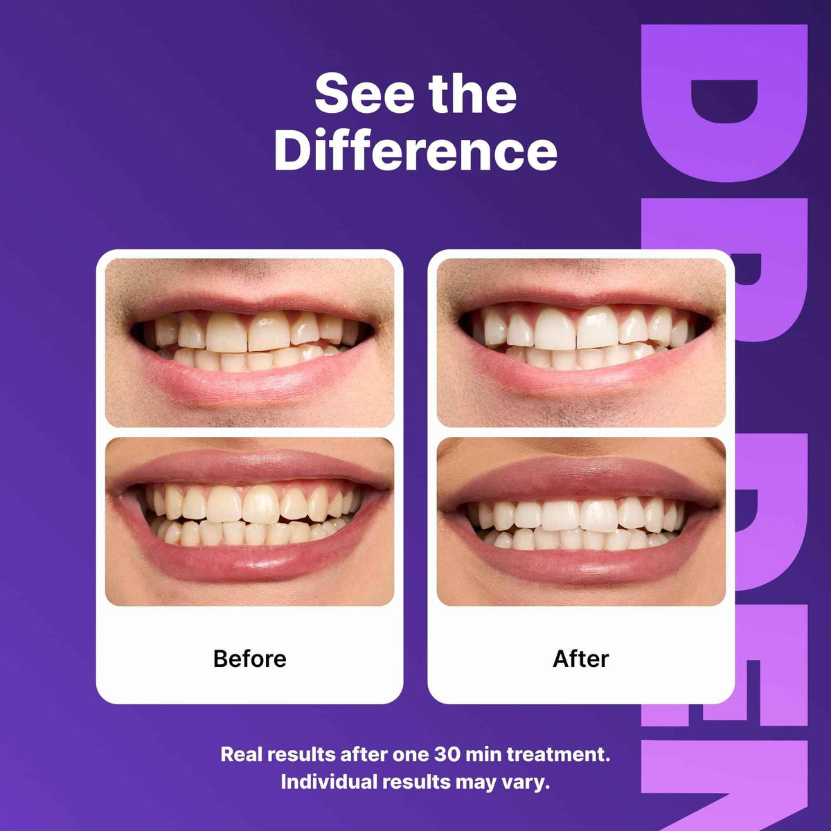 DRDENT Purple Teeth Whitening Strips 21 Treatments - Safe for Enamel - Non Sensitive Teeth Whitening